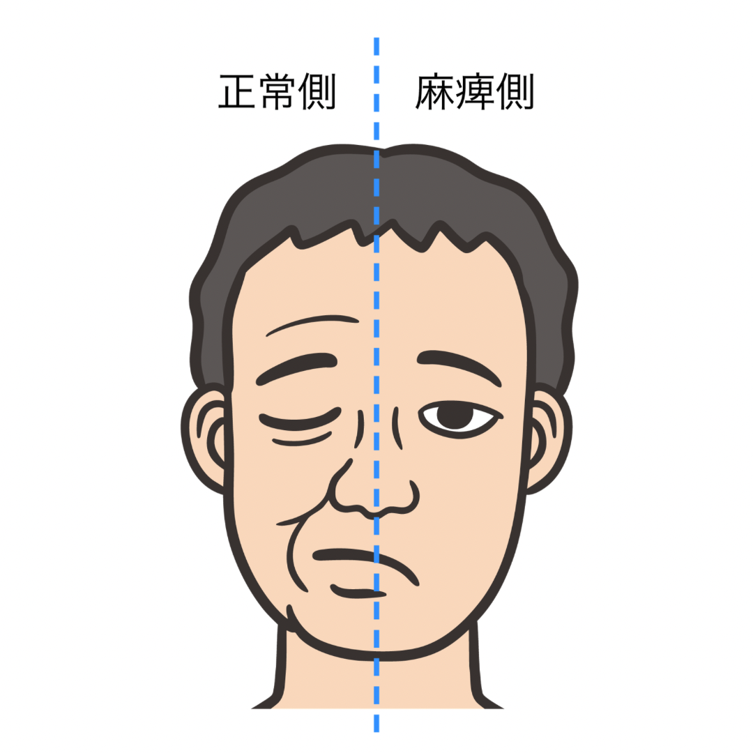 顔の左右非対称を示すイラスト。顔の中央に点線が引かれ、顔面神経麻痺による表情の歪みを視覚的に表している。